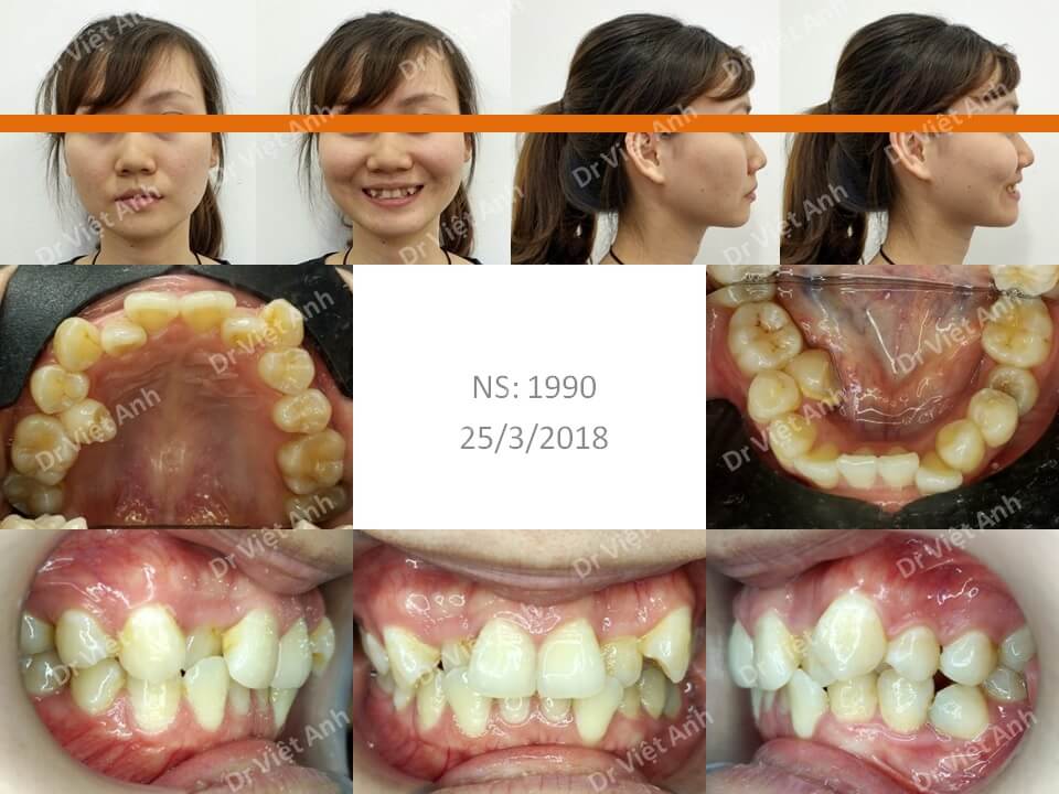 Niềng răng khấp khểnh nặng hoàn thành trong 21 tháng bằng mắc cài mặt lưỡi