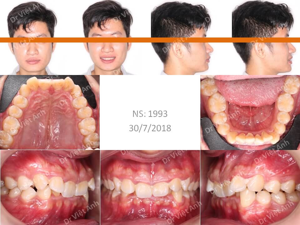 Niềng răng chữa khớp cắn sâu, răng lộn xộn, mặt ngắn sau 1,5 năm