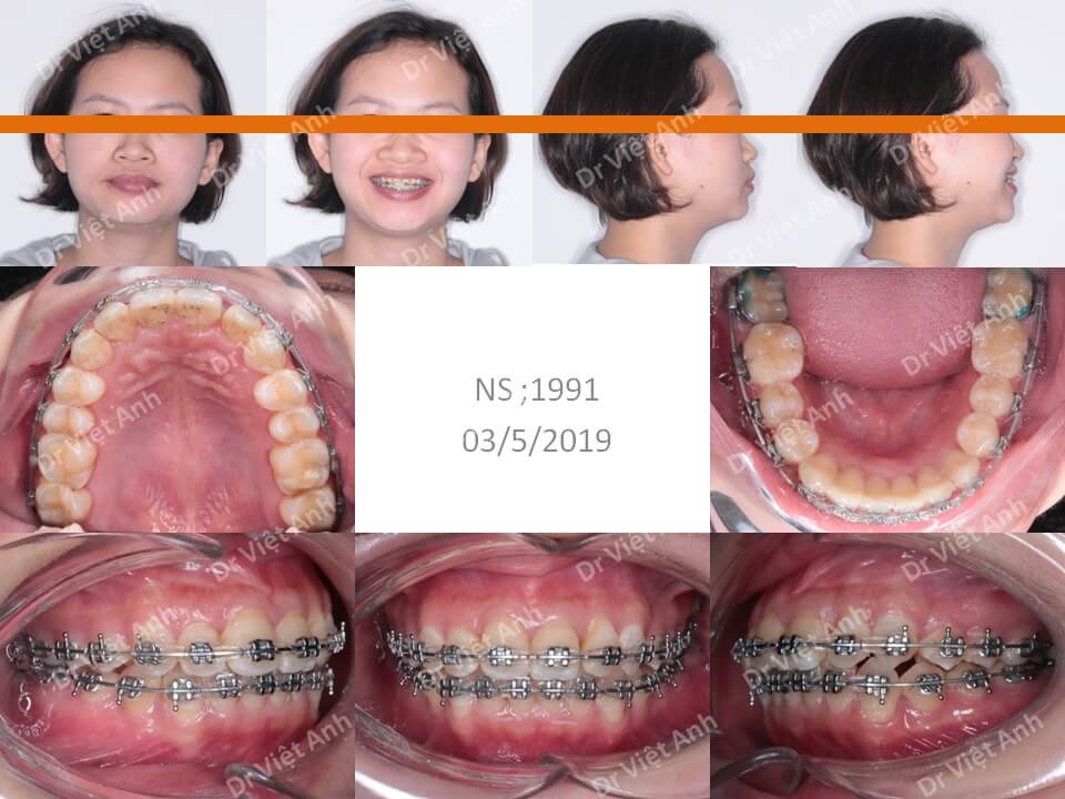 Niềng răng khấp khểnh, hô mà không cần nhổ răng, hoàn thành sau 13 tháng