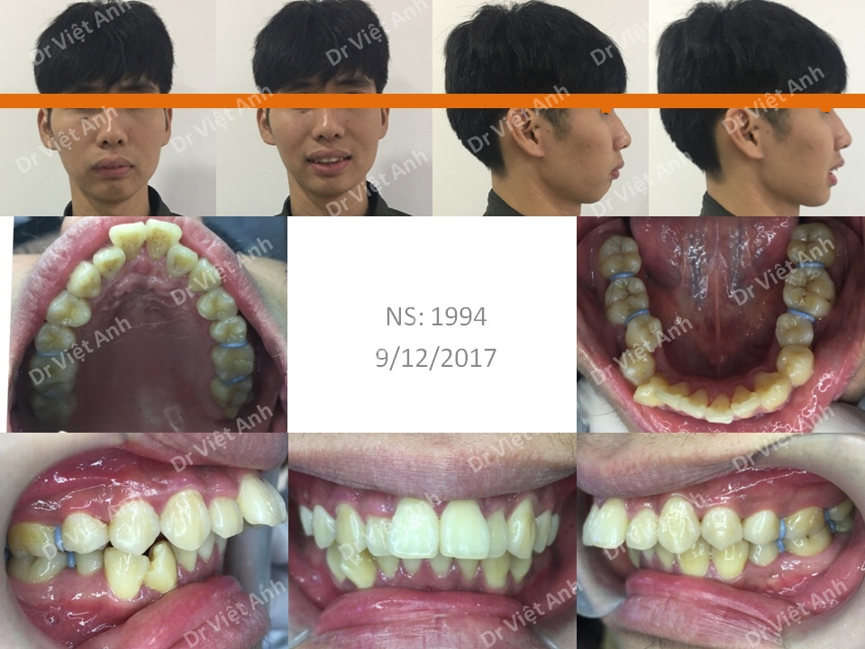 Ca niềng răng mặt trong đỉnh cao: khắc phục hô xương, cằm lẹm sau 2 năm
