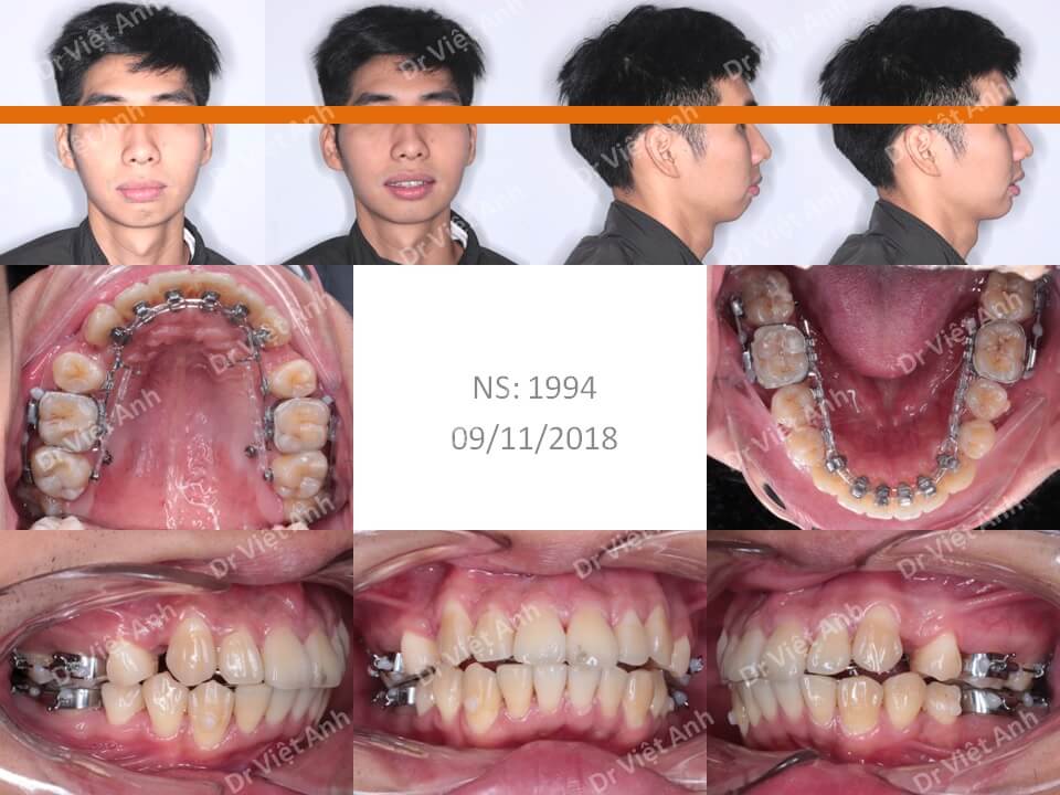 Ca niềng răng mặt trong đỉnh cao: khắc phục hô xương, cằm lẹm sau 2 năm