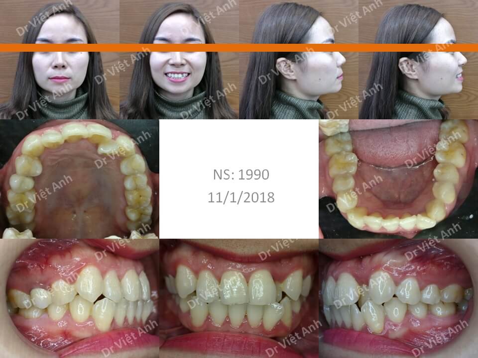 Niềng răng khểnh bằng mắc cài mặt lưỡi hoàn thành sau 2 năm