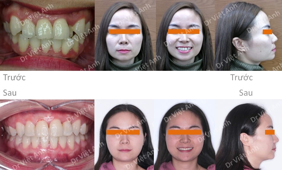 Niềng răng khểnh bằng mắc cài mặt lưỡi hoàn thành sau 2 năm