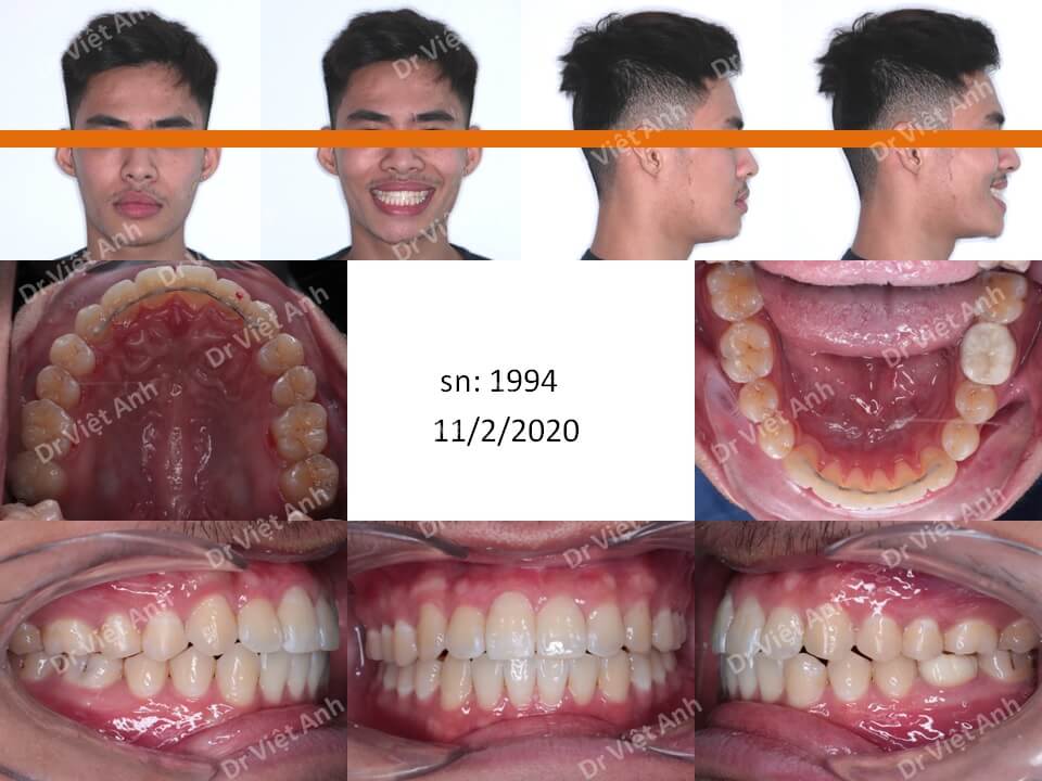 Niềng răng mặt trong khắc phục tình trạng lệch mặt, khớp cắn ngược sau 6 tháng