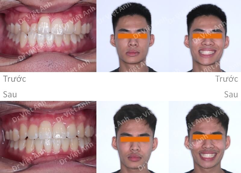 Niềng răng mặt trong khắc phục tình trạng lệch mặt, khớp cắn ngược sau 6 tháng
