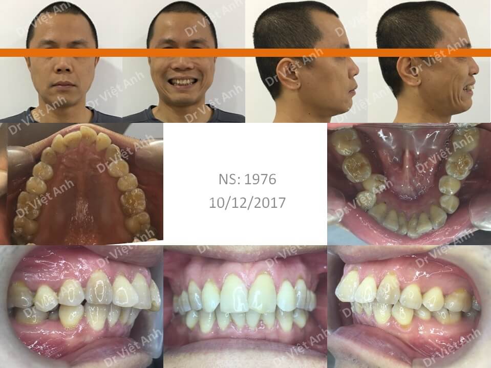 Niềng răng mặt lưỡi điều trị răng lộn xộn, hô cho khách hàng nam 41 tuổi