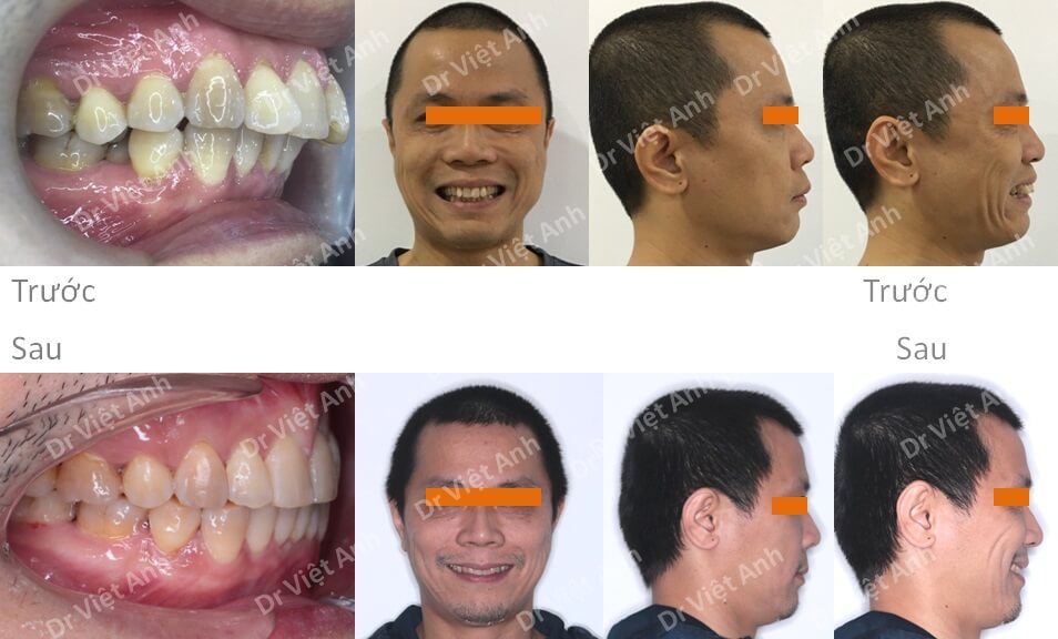 Niềng răng mặt lưỡi điều trị răng lộn xộn, hô cho khách hàng nam 41 tuổi