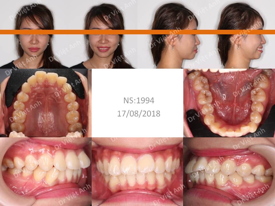 Góc nghiêng thay đổi hẳn sau 19 tháng niềng răng mặt trong chữa hô