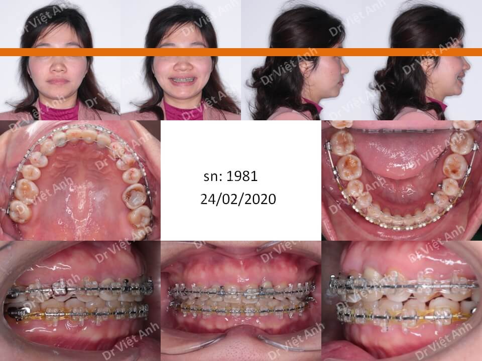 Niềng răng đóng kín khe thưa lớn sau khi nhổ răng kẹ cho khách hàng 38 tuổi