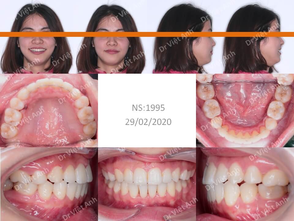 Niềng răng hô hoàn thành sau 1,5 năm bằng mắc cài mặt lưỡi