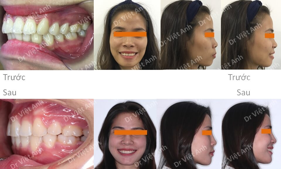 Niềng răng mặt trong chữa hô thành công, thay đổi khuôn mặt 3