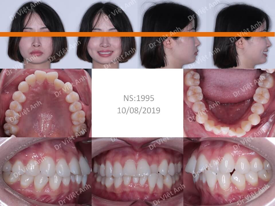 Niềng răng mặt lưỡi một ca răng lộn xộn, hô nhẹ nhỉ trong 10 tháng