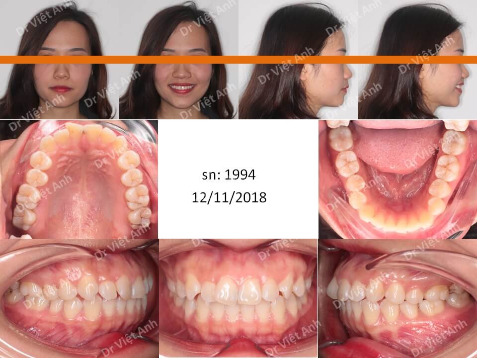Niềng răng khểnh, lộn xộn hoàn thành sau 1,5 năm bằng mắc cài mặt trong