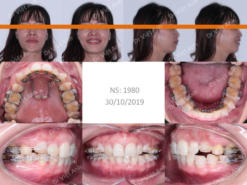 Niềng răng mặt trong một trường hợp hô hàm 38 tuổi hoàn thành sau 2 năm