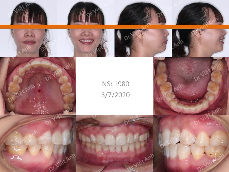Niềng răng mặt trong một trường hợp hô hàm 38 tuổi hoàn thành sau 2 năm
