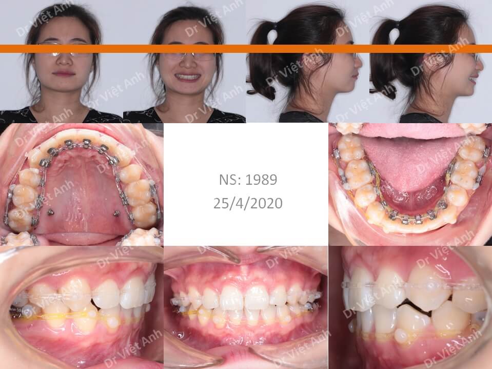 Niềng răng hô hàm trên, thiếu răng cửa dưới bằng mắc cài mặt lưỡi