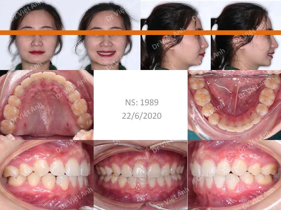 Niềng răng hô hàm trên, thiếu răng cửa dưới bằng mắc cài mặt lưỡi