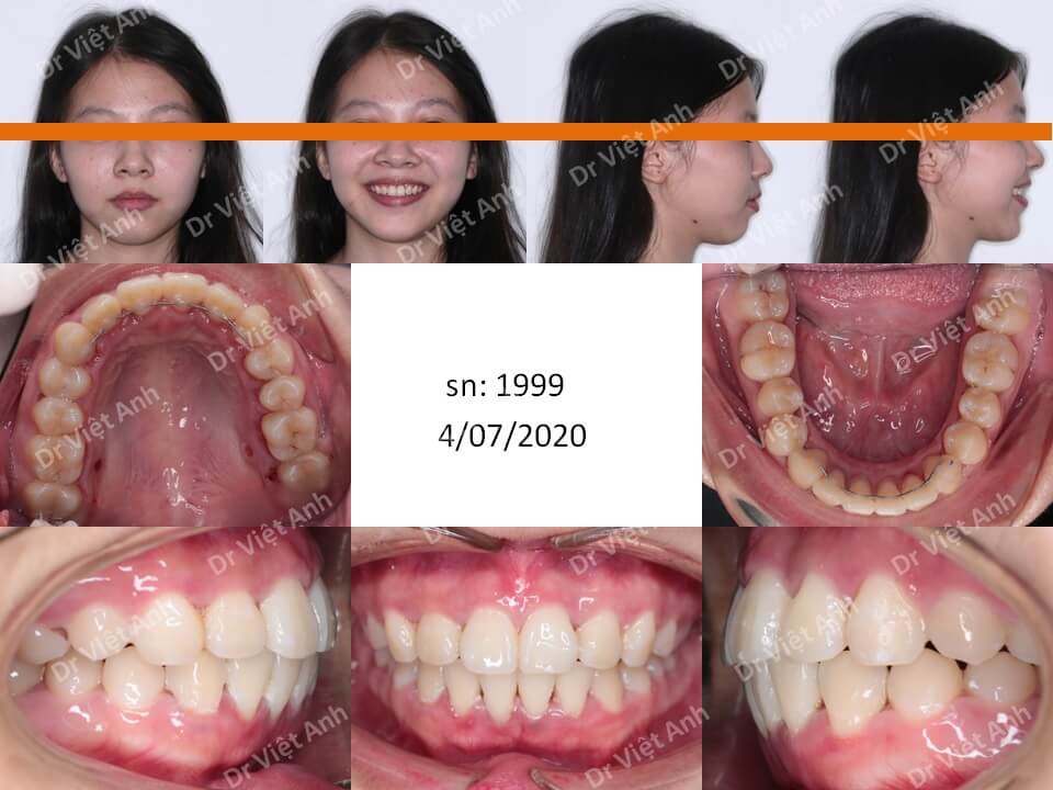 Một ca hô, lộn xộn, răng thưa được nắn chỉnh răng mặt lưỡi thành công mà không cần nhổ răng