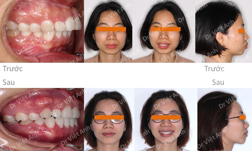 Niềng răng mặt trong điều trị thành công một ca hô hàm