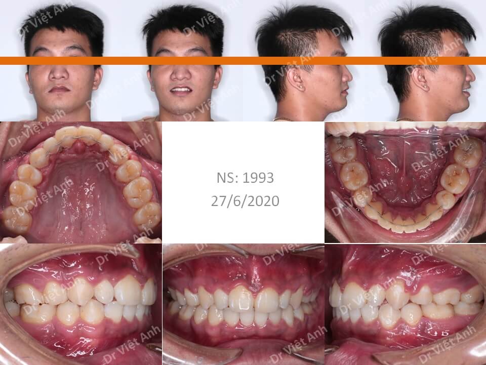 Thay đổi khuôn mặt - niềng răng hô cho một bạn nam bằng phương pháp niềng răng mặt lưỡi