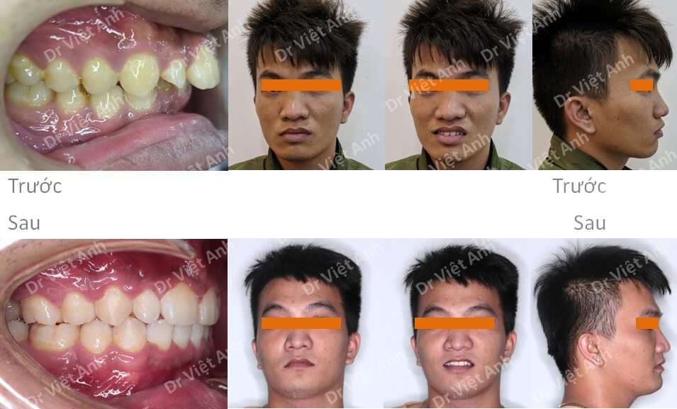 Thay đổi khuôn mặt - niềng răng hô cho một bạn nam bằng phương pháp niềng răng mặt lưỡi